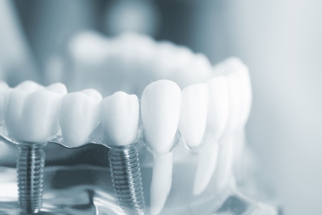 Top 13 địa chỉ trồng răng implant tại TPHCM uy tín nhất